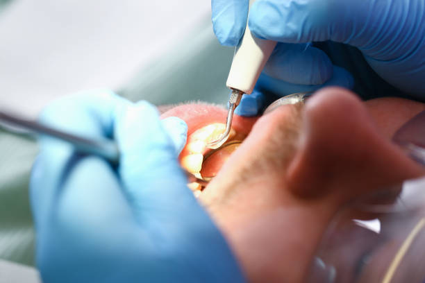 Best Emergency Dentist for Lost Fillings or Crowns in Saxapahaw, NC